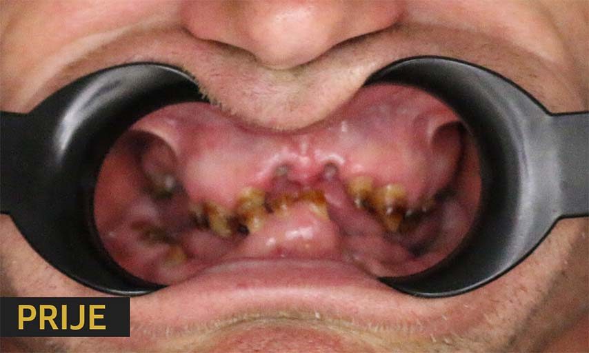 Patient status prior to implant placement