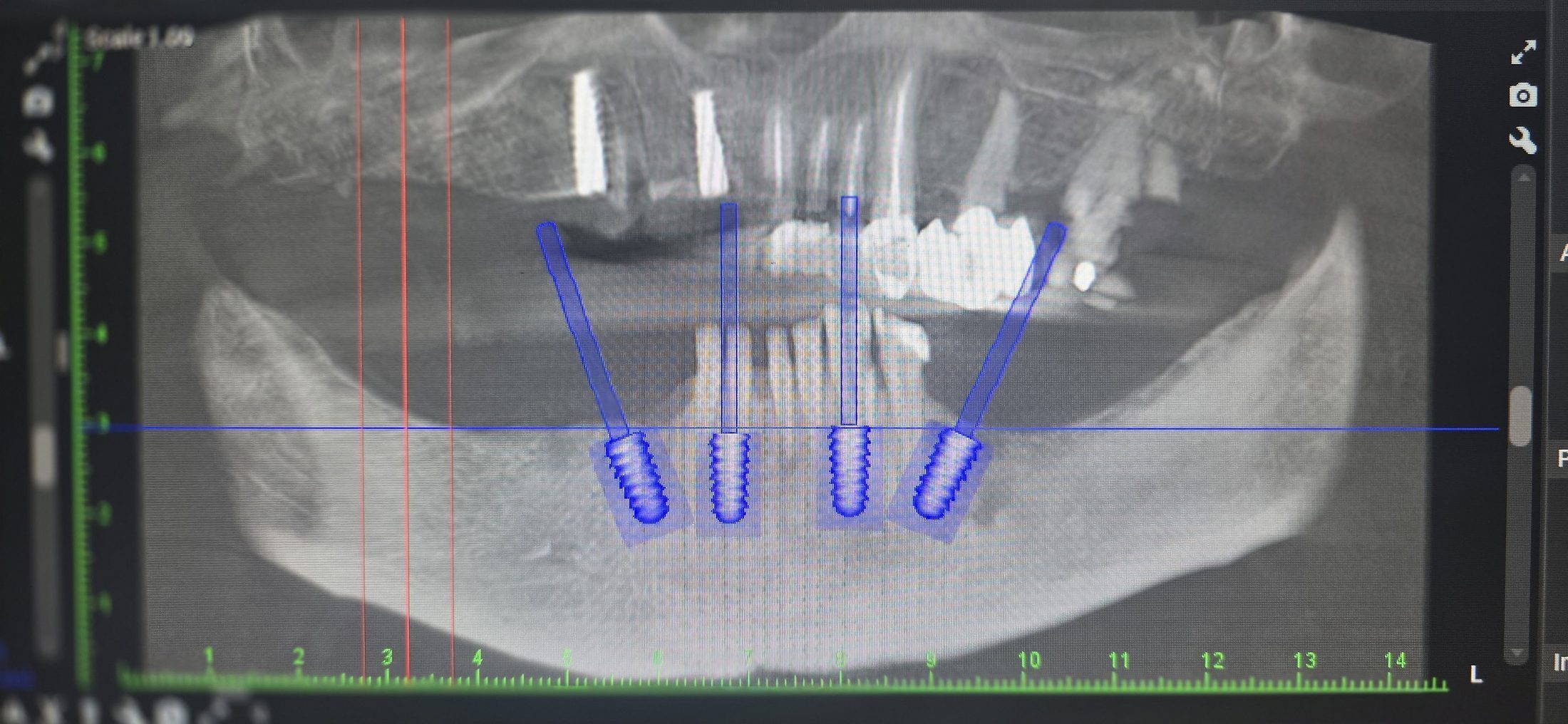 CBCT 3D jaw imaging for implant planning