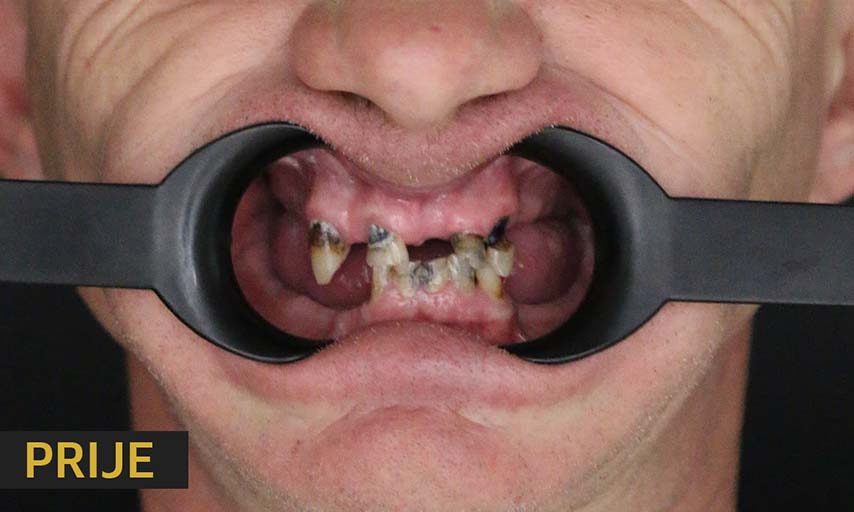 Patient status prior to implant placement