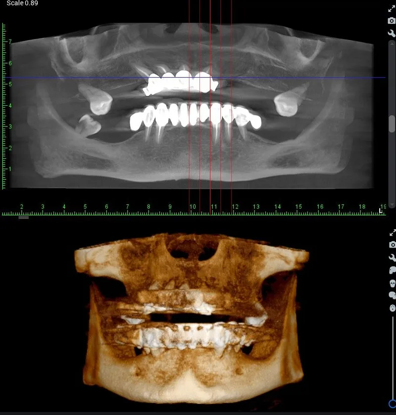 CBCT 3D snimka