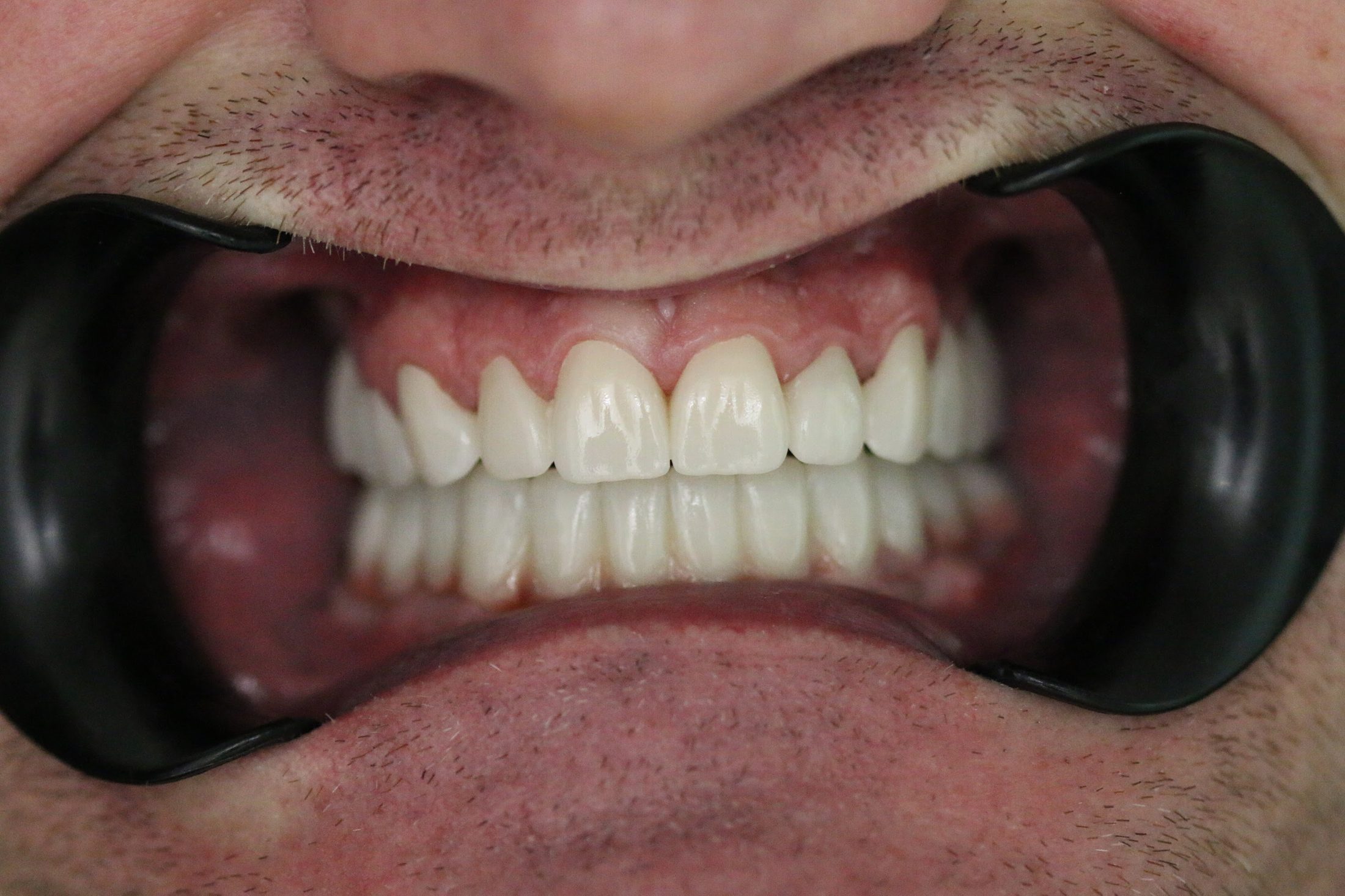 Zirconia restorations crafted in our laboratory for All-on-4