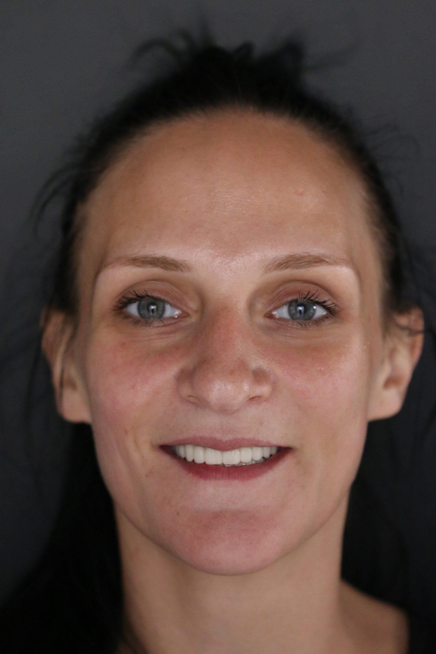 Happy patient after an All-on-4 procedure in Bjelovar